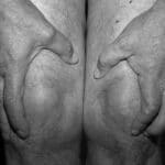Scientists are racing to find ways to diagnose osteoarthritis earlier and stave off or slow some of the damage from the disease, which affects over 32.5 million adults in the United States and more than 500 million people worldwide. (Patricia Voulgaris/Th